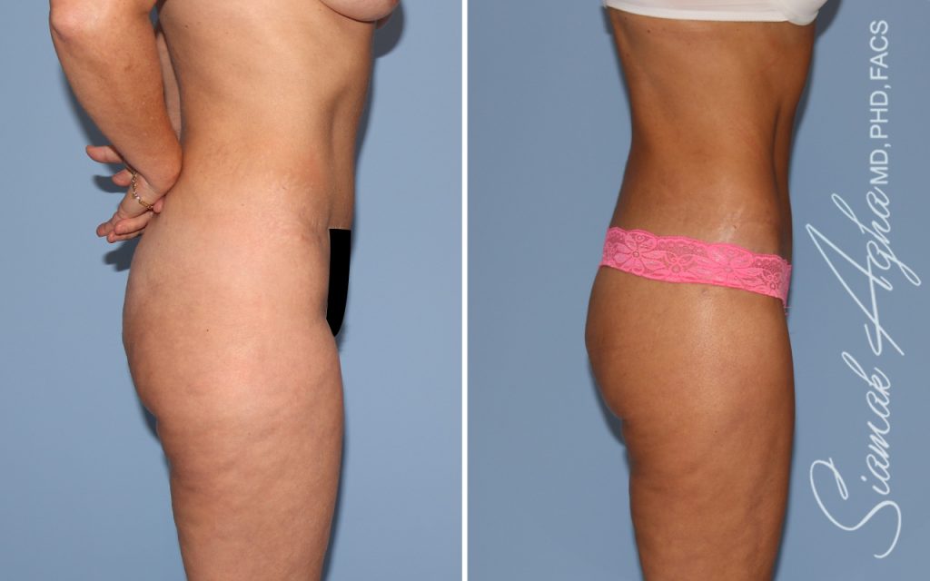 Lower Body Lift Surgery