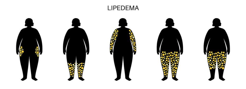 Lipedema disease - Image shows occurences in different parts of the body