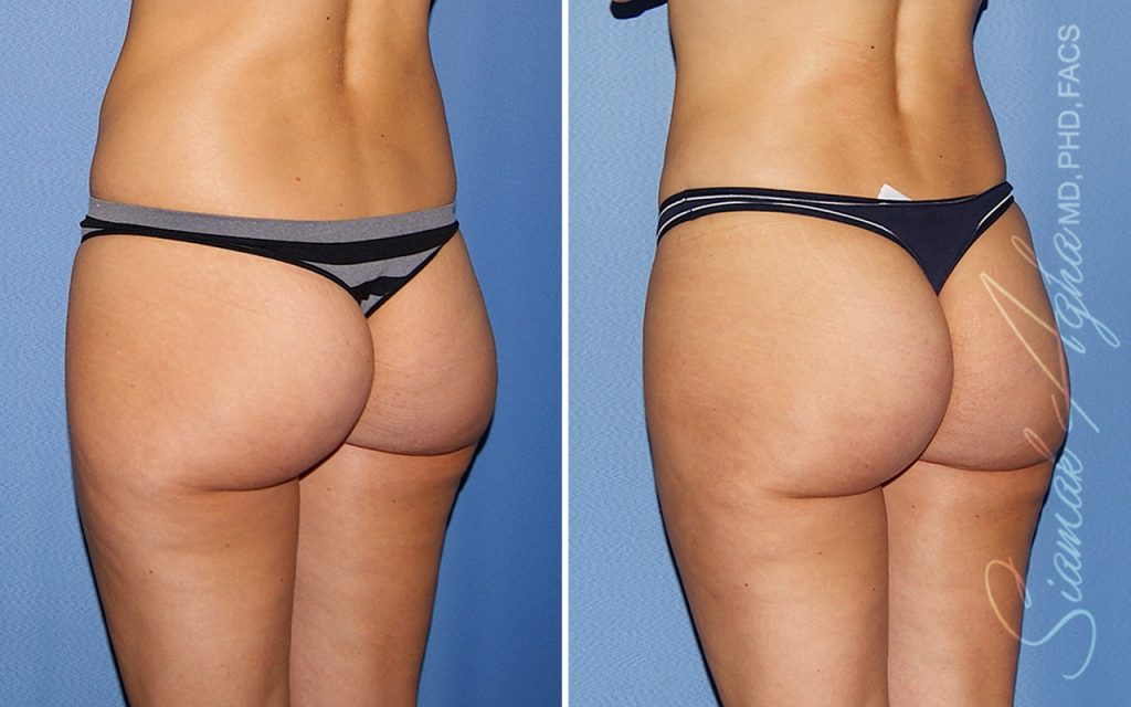 Plastic Surgery After GLP-1 Medications