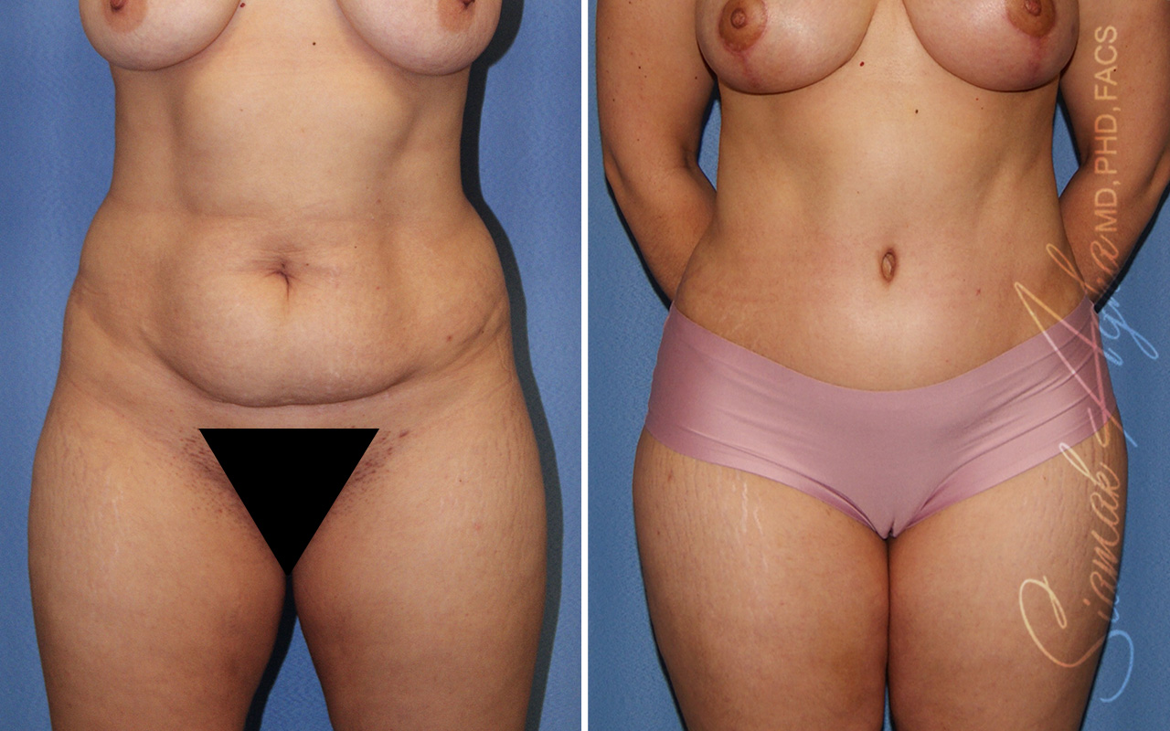 Combined Tummy Tuck and Brazilian Butt Lift Patient 47