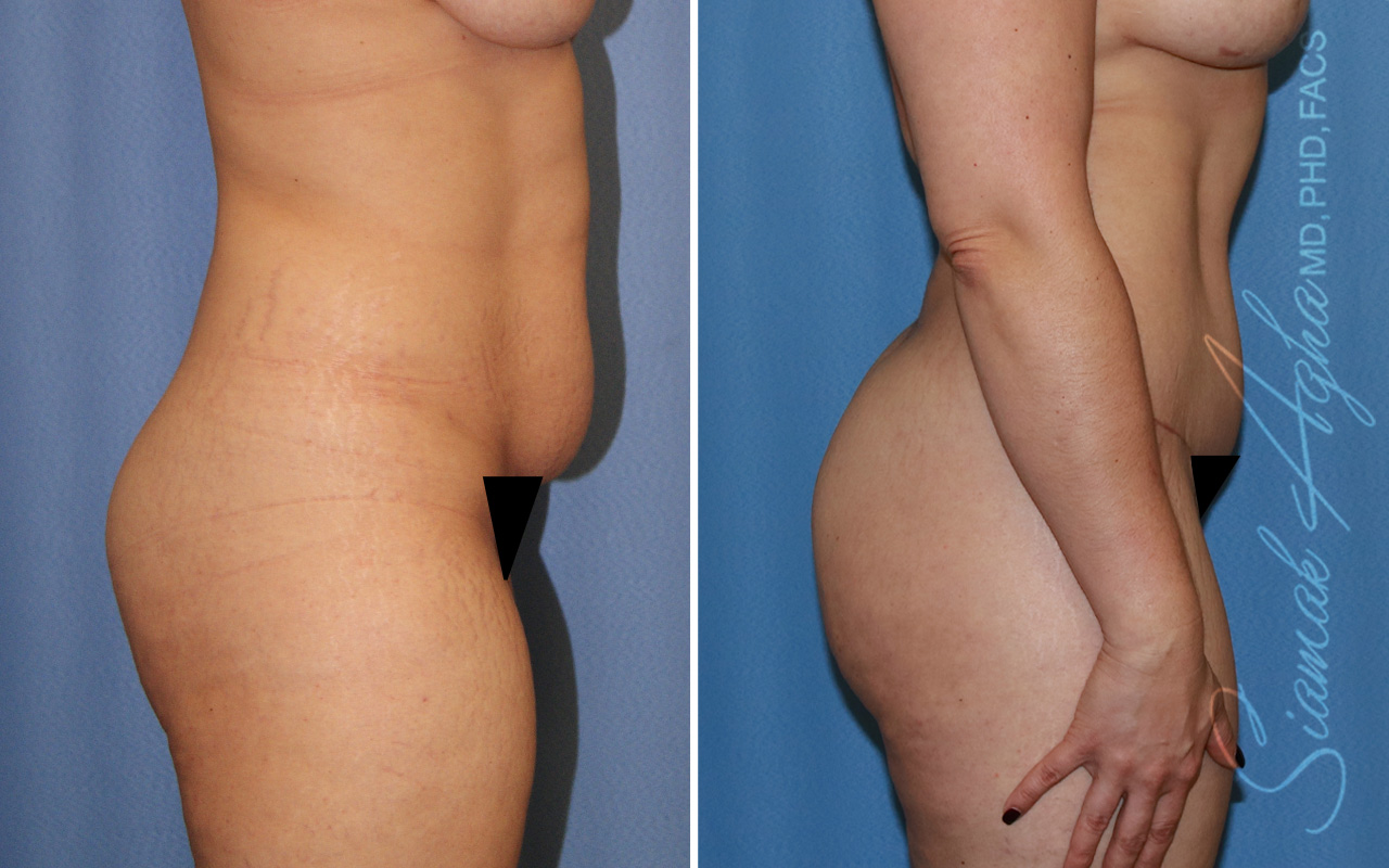 Combined Tummy Tuck and Brazilian Butt Lift Patient 47