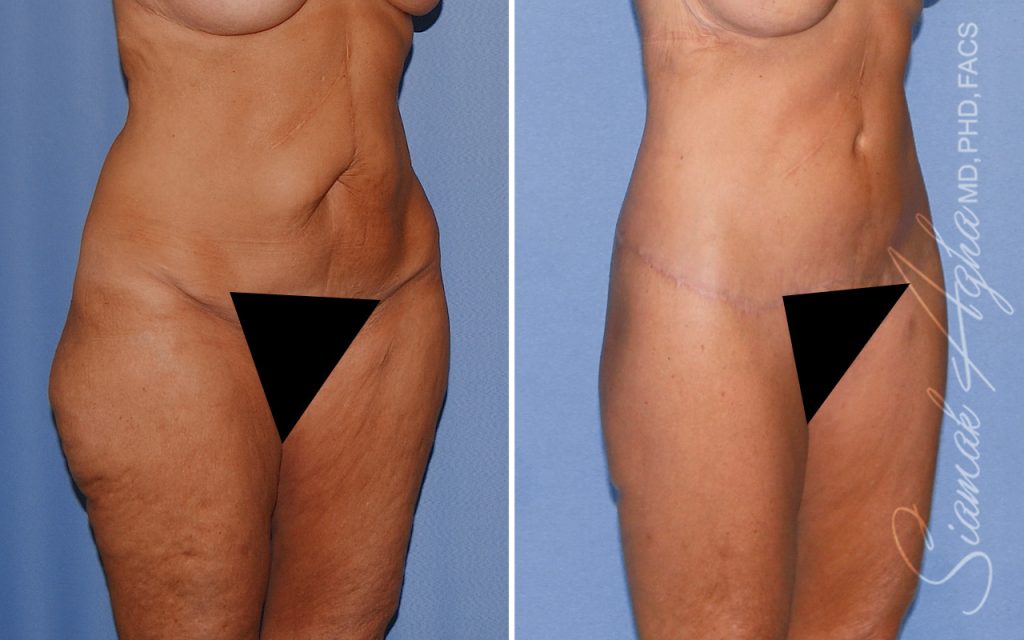 Plastic Surgery After GLP-1 Medications