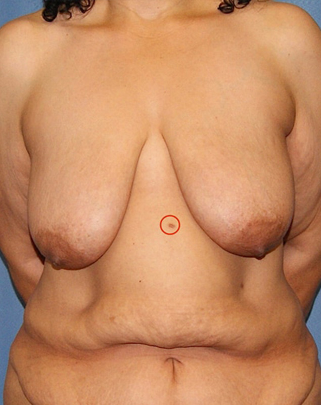 Breast Lift - Internal Dermal Bra - Patient 26 - Before