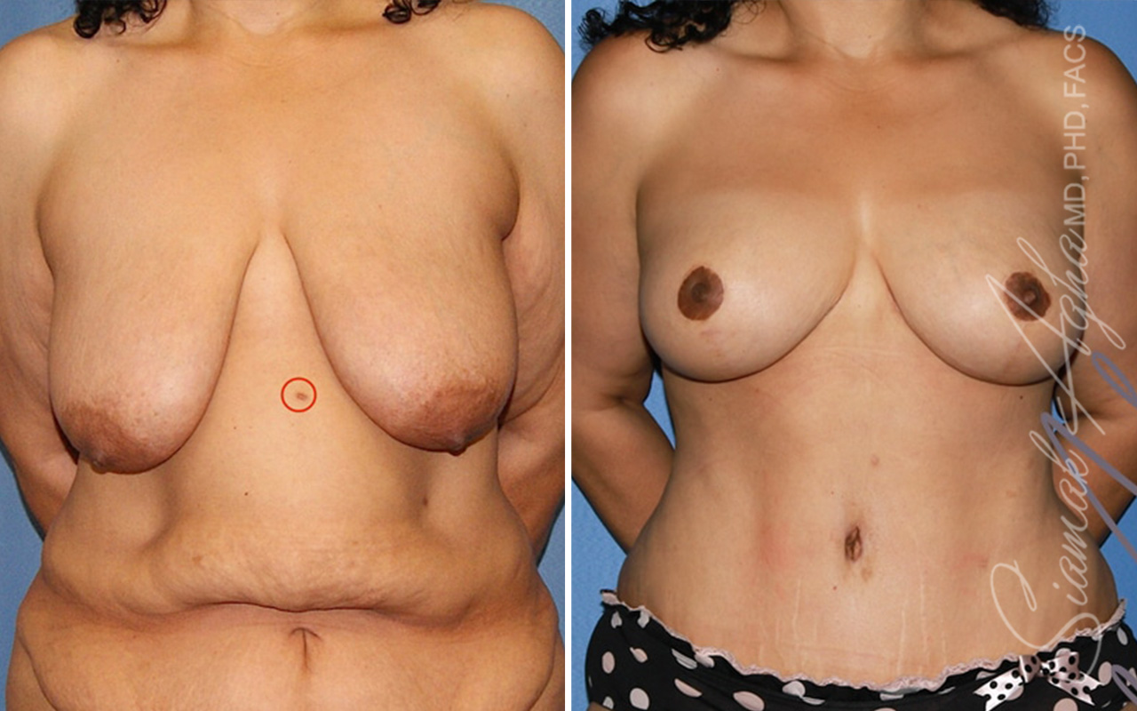 Breast Lift - Internal Dermal Bra - Patient 26 - Before and After -Front
