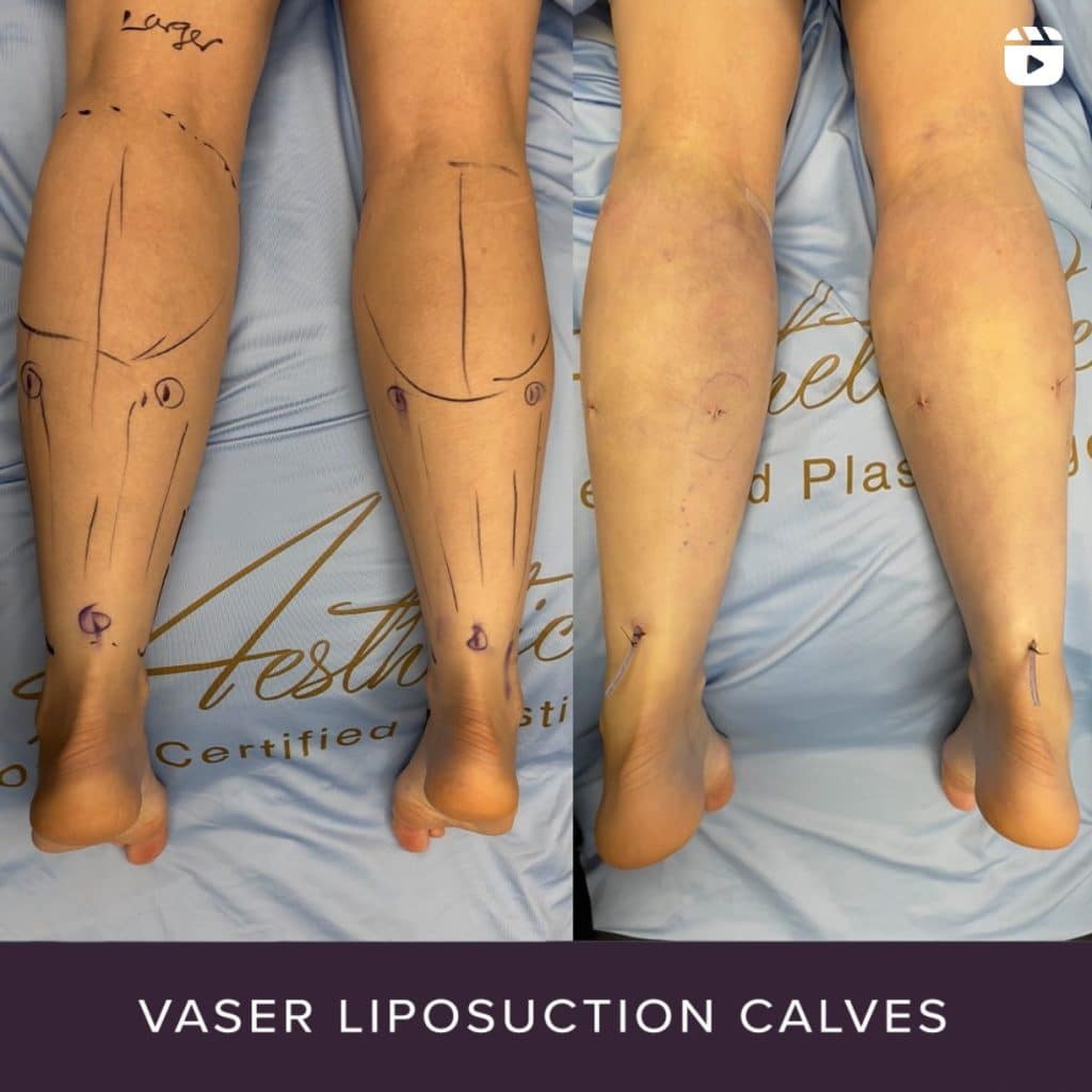 Calf vaser liposuction - Instagram Reel