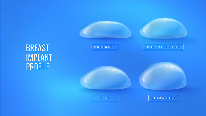 Graphic of breast implant profiles: moderate, moderate plus, high and ultra-high