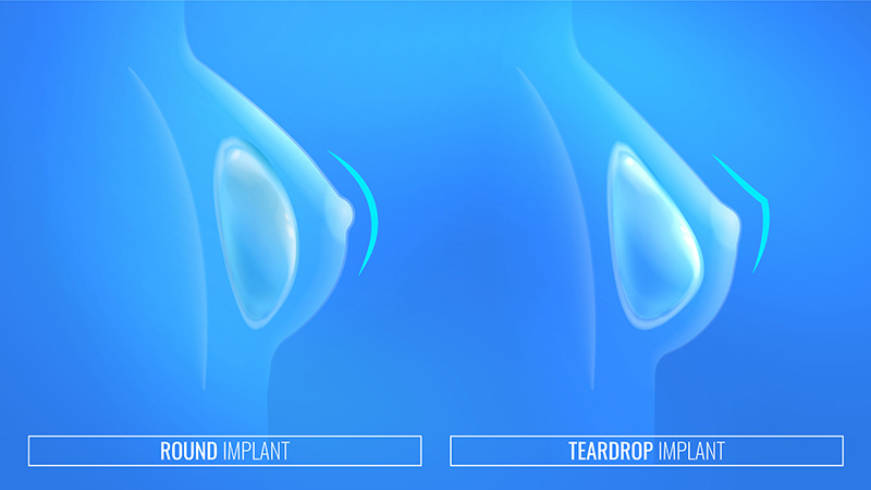 Graphic of round and teardrop implants inside of breasts