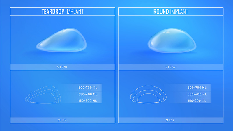 Graphic of teardrop and round implants in different sizes