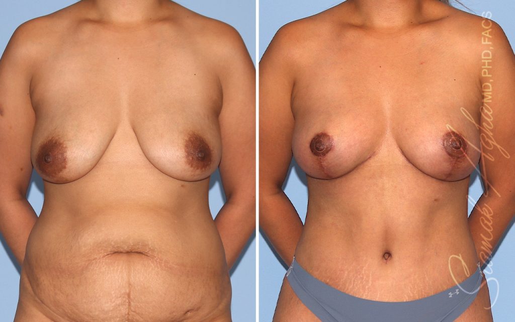 Plastic Surgery After GLP-1 Medications