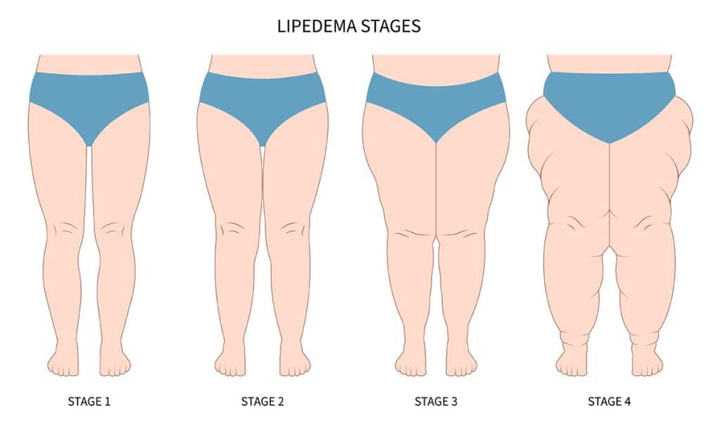 Graphic showing lipedema stages illustration