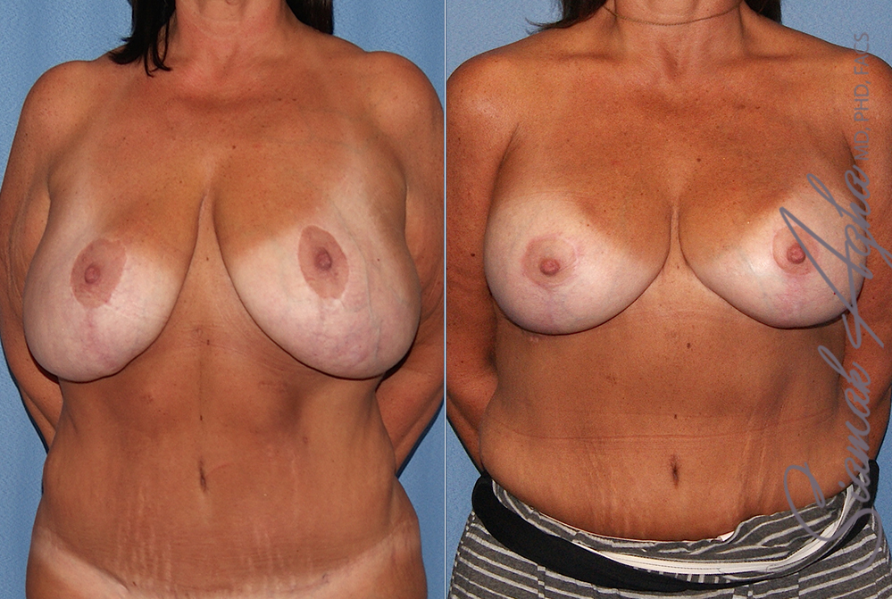 Breast Lift with Augmentation