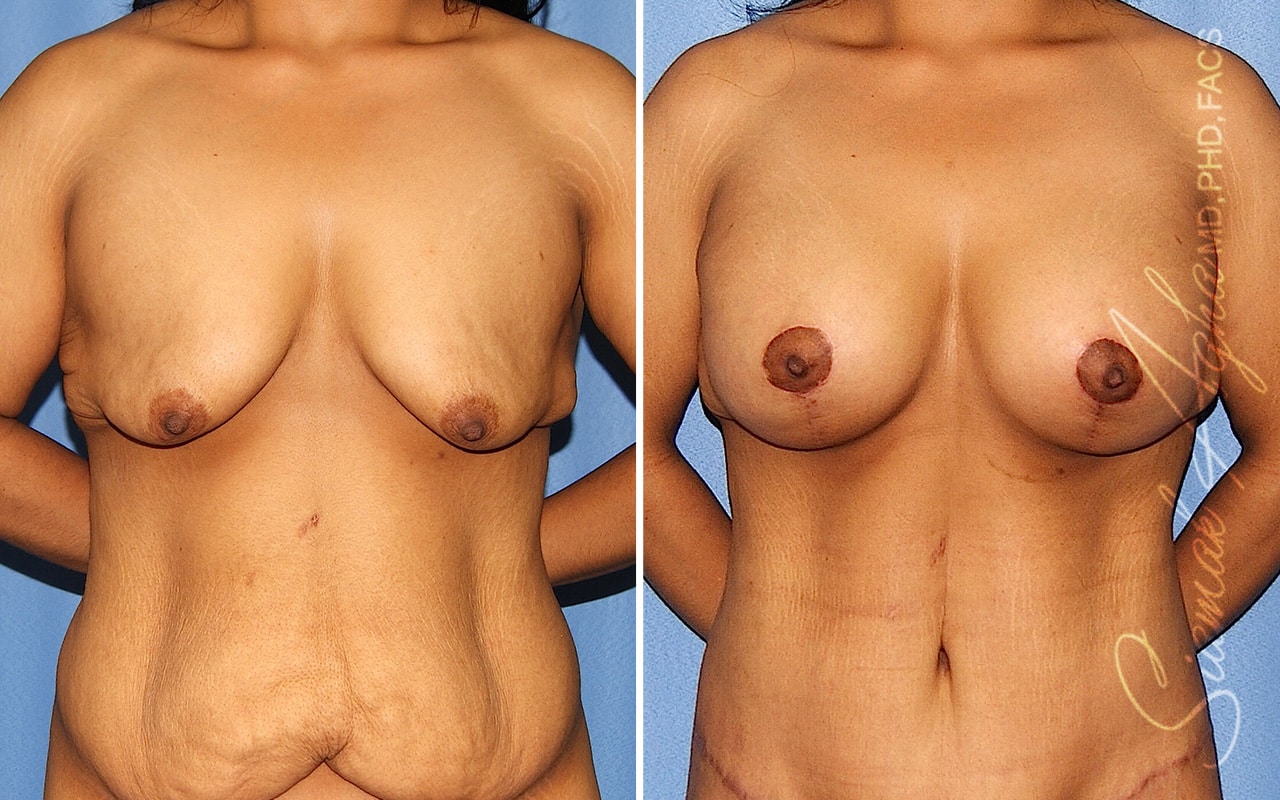 Tubular Breast Correction