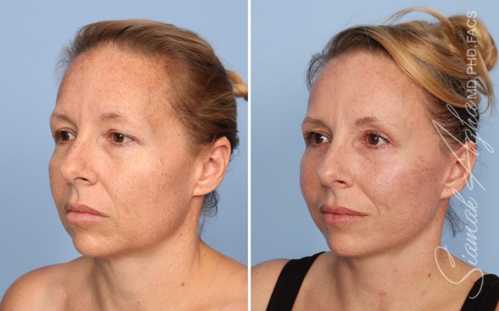 Facelift Landing Page New