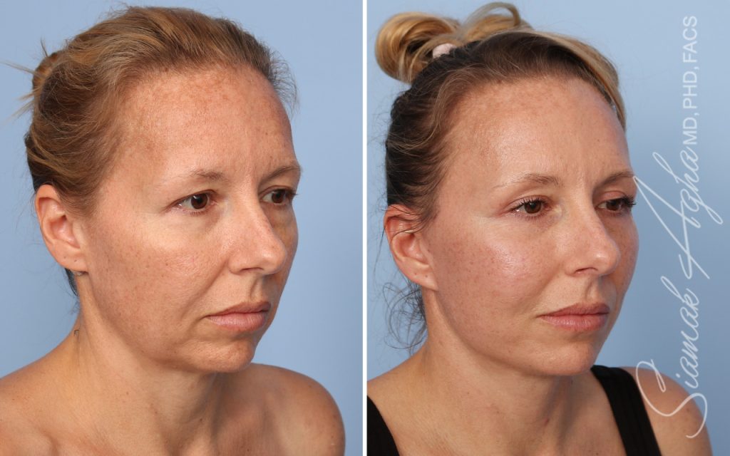 Facelift Landing Page New