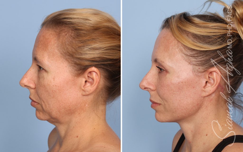 Facelift Landing Page New
