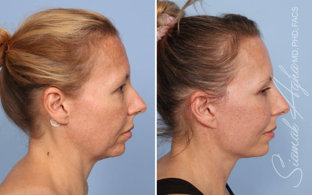 Facelift Landing Page New