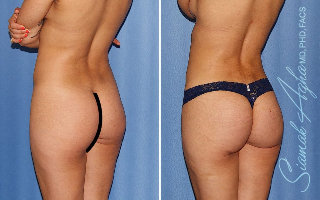 Plastic Surgery After GLP-1 Medications