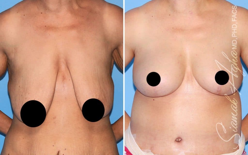 Plastic Surgery After GLP-1 Medications